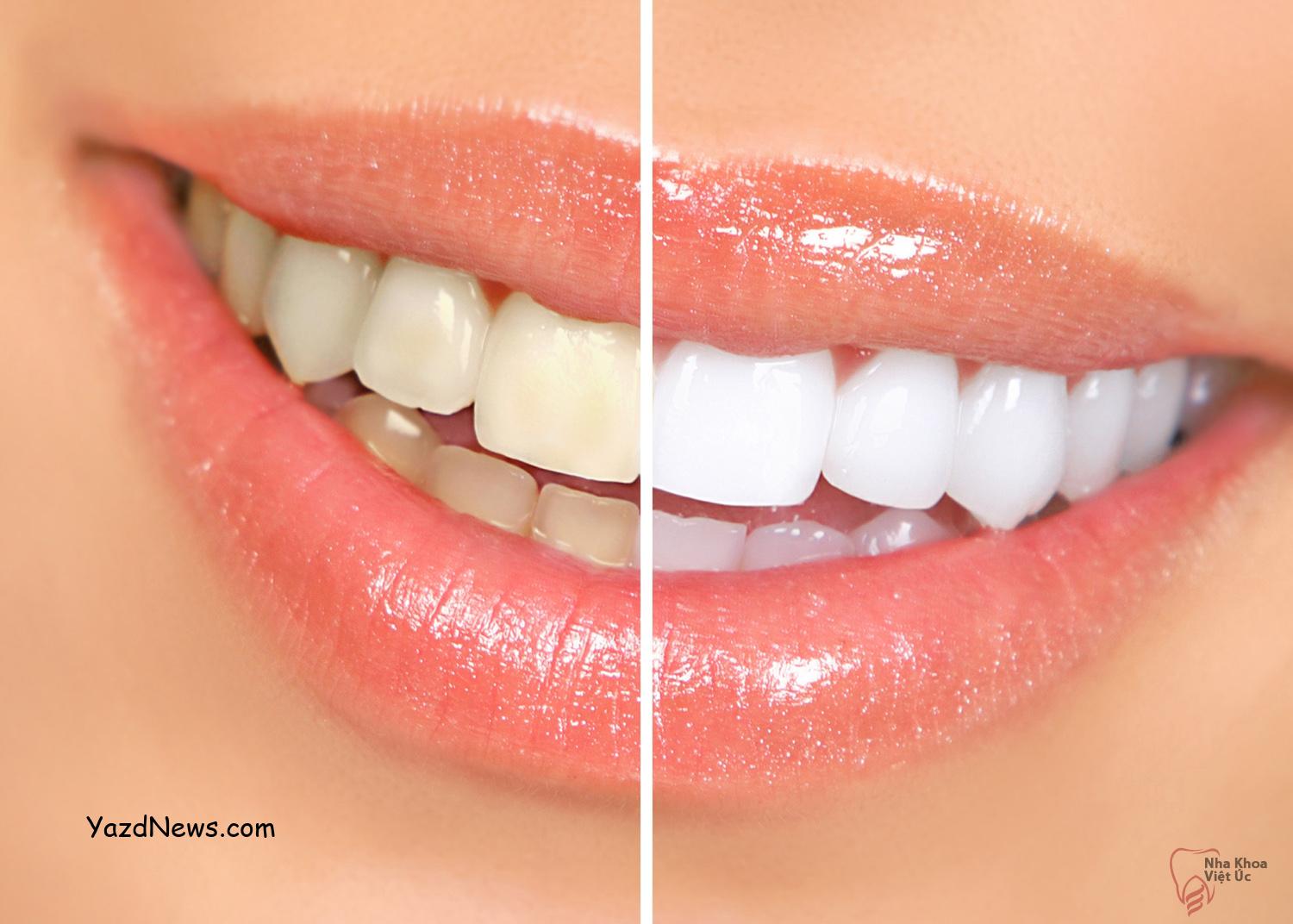 راهکارهای عالی برای سفید کردن دندان در خانه