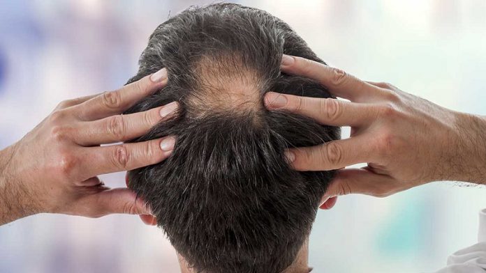 چه موقع باید برای ریزش مو با پزشک مشورت کنید